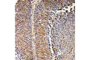 Immunohistochemical analysis of SH2D2A staining in human liver cancer formalin fixed paraffin embedded tissue section. (SH2D2A Antikörper)