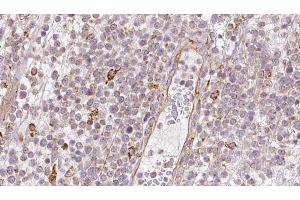 ABIN6273202 at 1/100 staining Human lymph cancer tissue by IHC-P. (BBS4 Antikörper  (Internal Region))