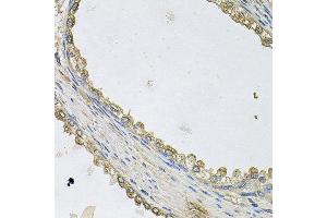 Immunohistochemistry of paraffin-embedded human prostate using MTERFD1 antibody at dilution of 1:100 (x40 lens). (MTERFD1 Antikörper)
