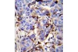 Immunohistochemistry analysis in formalin fixed and paraffin embedded human breast carcinoma reacted PIP / GCDFP15 Antibody (C-term) followed by peroxidase conjugation of the secondary antibody and DAB staining. (PIP Antikörper  (C-Term))