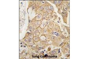 Formalin-fixed and paraffin-embedded human lung carcinoma tissue reacted with ADCY2 antibody (C-term) (ABIN389223 and ABIN2839376) , which was peroxidase-conjugated to the secondary antibody, followed by DAB staining.