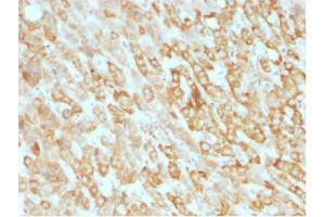 Formalin-fixed, paraffin-embedded human Hepatic Carcinoma stained with Prohibitin Mouse Monoclonal Antibody (SPM311). (Prohibitin Antikörper  (AA 167-261))