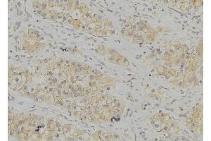 ABIN6272936 at 1/100 staining Human breast cancer tissue by IHC-P.