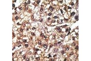 IHC analysis of FFPE human hepatocarcinoma tissue stained with the PINK1 antibody (PINK1 Antikörper  (AA 118-147))