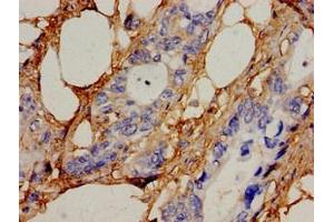 Immunohistochemistry analysis of human pancreatic cancer using ABIN7169051 at dilution of 1:100 (ICK Antikörper  (AA 150-275))