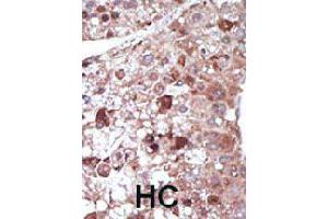 Formalin-fixed and paraffin-embedded human hepatocellular carcinoma tissue reacted with PCK1 polyclonal antibody  , which was peroxidase-conjugated to the secondary antibody, followed by DAB staining. (PCK1 Antikörper  (N-Term))