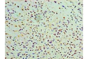 Immunohistochemistry of paraffin-embedded human breast cancer using ABIN7174611 at dilution of 1:100 (GALE Antikörper  (AA 1-348))