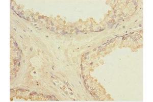 Immunohistochemistry of paraffin-embedded human prostate cancer using ABIN7158367 at dilution of 1:100 (LMO4 Antikörper  (AA 1-165))
