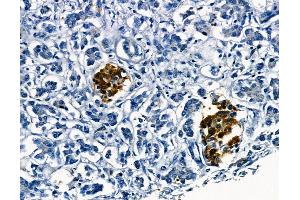 ABIN6265446 and ABIN6278639 at 1/100 staining human gastric cancer by IHC-P.