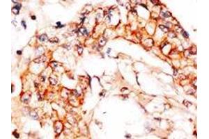 Formalin-fixed and paraffin-embedded human breast carcinoma reacted with anti-APPBP1 (C-term), which was peroxidase-conjugated to the secondary antibody, followed by DAB staining. (NAE1 Antikörper  (C-Term))