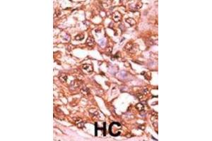 Immunohistochemistry (IHC) image for anti-Signal Transducer and Activator of Transcription 5A (STAT5A) (pSer726) antibody (ABIN5021402) (STAT5A Antikörper  (pSer726))