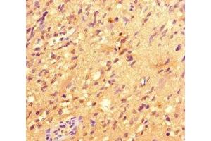 Immunohistochemistry of paraffin-embedded human glioma using ABIN7147801 at dilution of 1:100 (IRG1 Antikörper  (AA 57-257))