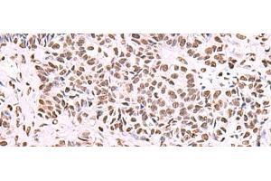 Immunohistochemistry of paraffin-embedded Human ovarian cancer tissue using NASP Polyclonal Antibody at dilution of 1:55(x200) (NASP Antikörper)