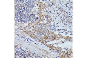 Immunohistochemistry of paraffin-embedded human lung cancer using Cortactin antibody  at dilution of 1:100 (40x lens). (Cortactin Antikörper  (AA 1-200))