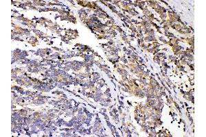 PRKAR1A was detected in paraffin-embedded sections of human lung cancer tissues using rabbit anti- PRKAR1A Antigen Affinity purified polyclonal antibody (Catalog # ) at 1 µg/mL. (PRKAR1A Antikörper  (AA 2-81))