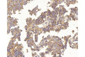 Immunohistochemistry analysis of paraffin-embedded human stomach cancer using TEK Polyclonal Antibody at dilution of 1:200. (TEK Antikörper)