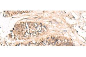 Immunohistochemistry of paraffin-embedded Human colorectal cancer tissue using ABCB4 Polyclonal Antibody at dilution of 1:70(x200) (ABCB4 Antikörper)