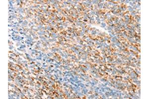 The image on the left is immunohistochemistry of paraffin-embedded Human ovarian cancer tissue using ABIN7192795(THY1 Antibody) at dilution 1/25, on the right is treated with synthetic peptide. (CD90 Antikörper)