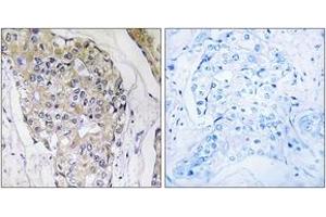 Immunohistochemistry analysis of paraffin-embedded human breast carcinoma tissue, using NDUFS6 Antibody. (NDUFS6 Antikörper  (AA 75-124))