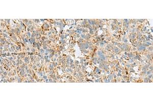 Immunohistochemistry of paraffin-embedded Human cervical cancer tissue using VDAC3 Polyclonal Antibody at dilution of 1:30(x200) (VDAC3 Antikörper)