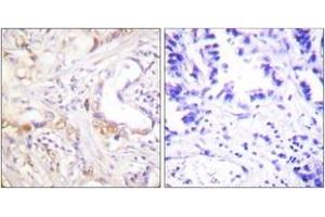 Immunohistochemistry analysis of paraffin-embedded human lung carcinoma tissue, using PIAS3 Antibody. (PIAS3 Antikörper  (AA 10-59))