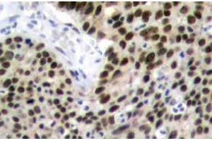 Immunohistochemistry (IHC) analyzes of HSF1 antibody in paraffin-embedded human breast carcinoma tissue. (HSF1 Antikörper)