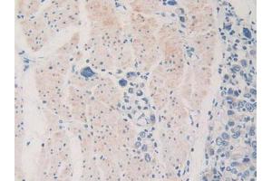 IHC-P analysis of Human Stomach Cancer Tissue, with DAB staining. (PDHX Antikörper  (AA 220-468))