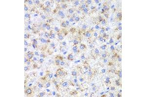 Immunohistochemistry of paraffin-embedded human liver cancer using HAO1 antibody.