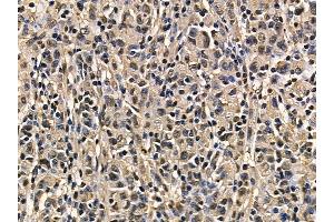 MCM3 Mouse Monoclonal Antibody at 1/100 staining human gastric cancer by IHC-P.