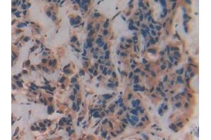 Detection of VAV3 in Human Breast cancer Tissue using Polyclonal Antibody to Vav 3 Oncogene (VAV3) (VAV3 Antikörper  (AA 183-380))