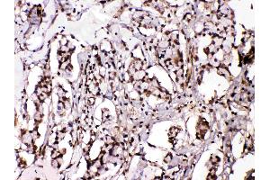 Islet 1 was detected in paraffin-embedded sections of human mammary cancer tissues using rabbit anti- Islet 1 Antigen Affinity purified polyclonal antibody (Catalog # ) at 1 µg/mL. (ISL1 Antikörper  (Middle Region))