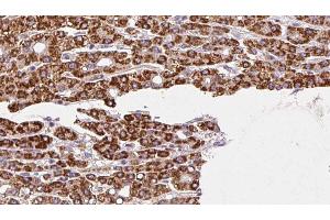 ABIN6272458 at 1/100 staining Human liver cancer tissue by IHC-P. (Vomeronasal 1 Receptor 3 (VMN1R3) Antikörper)