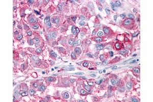 Anti-NPY1R antibody IHC of human Skin, Melanoma. (NPY1R Antikörper  (Cytoplasmic Domain))