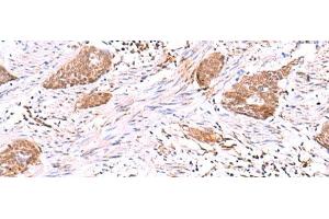 Immunohistochemistry of paraffin-embedded Human esophagus cancer tissue using SASH1 Polyclonal Antibody at dilution of 1:30(x200) (SASH1 Antikörper)