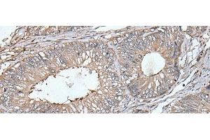 Immunohistochemistry of paraffin-embedded Human colorectal cancer tissue using UNC13B Polyclonal Antibody at dilution of 1:40(x200) (UNC13B Antikörper)