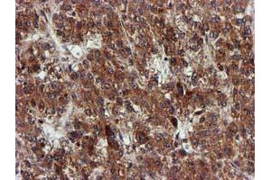 Immunohistochemical staining of paraffin-embedded Carcinoma of Human liver tissue using anti-EPM2AIP1 mouse monoclonal antibody. (EPM2AIP1 Antikörper)