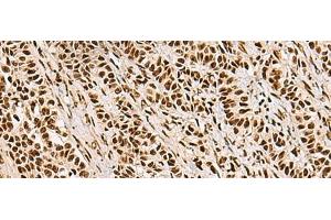 Immunohistochemistry of paraffin-embedded Human ovarian cancer tissue using FOXI1 Polyclonal Antibody at dilution of 1:55(x200) (FOXI1 Antikörper)