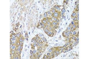 Immunohistochemistry of paraffin-embedded Human prostate cancer using PEX14 Polyclonal Antibody at dilution of 1:100 (40x lens). (PEX14 Antikörper)