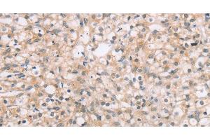 Immunohistochemistry of paraffin-embedded Human prostate cancer tissue using ROR1 Polyclonal Antibody at dilution 1:45 (ROR1 Antikörper)