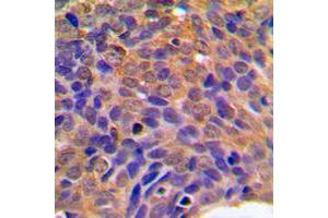 Immunohistochemical analysis of Beta-catenin staining in human breast cancer formalin fixed paraffin embedded tissue section. (beta Catenin Antikörper  (C-Term))