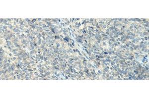 Immunohistochemistry of paraffin-embedded Human ovarian cancer tissue using NPVF Polyclonal Antibody at dilution of 1:80(x200) (NPVF Antikörper)