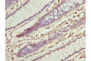 Immunohistochemistry of paraffin-embedded human colon cancer using ABIN7142940 at dilution of 1:100 (ILVBL Antikörper  (AA 45-344))