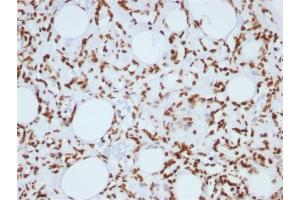 Formalin-fixed, paraffin-embedded human Angiosarcoma stained with Histone H1 Mouse Monoclonal Antibody (1415-1) (Histone H1 Antikörper)