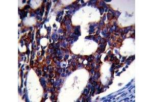 TGFB2 antibody analysis in formalin fixed and paraffin embedded human breast carcinoma. (TGFB2 Antikörper)