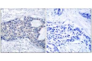 Immunohistochemical analysis of paraffin-embedded human breast carcinoma tissue, using Zap-70 (phospho-Tyr493) antibody (E011160). (ZAP70 Antikörper  (pTyr493))