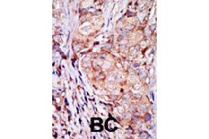 Formalin-fixed and paraffin-embedded human breast cancer tissue reacted with TRIB3 polyclonal antibody  , which was peroxidase-conjugated to the secondary antibody, followed by AEC staining. (TRIB3 Antikörper  (N-Term))