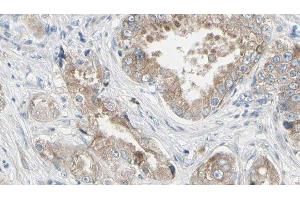 ABIN6279342 at 1/100 staining Human prostate tissue by IHC-P. (PLA2G4F Antikörper  (C-Term))