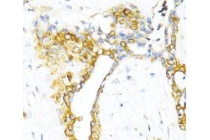 Immunohistochemistry of paraffin-embedded Human breast using CTGF Polyclonal Antibody at dilution of 1:100 (40x lens).