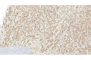 Immunohistochemistry of paraffin-embedded Human breast cancer tissue using Cleaved-CASP1 (D210) Polyclonal Antibody at dilution of 1:200. (Caspase 1 Antikörper  (Cleaved-Asp210))