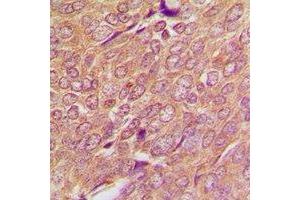 Immunohistochemical analysis of SREBP1 staining in human breast cancer formalin fixed paraffin embedded tissue section. (SREBF1 Antikörper)